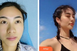 唐山美泉醫(yī)療美容診所吉云麗整形價格表附耳軟骨復(fù)合隆鼻案例展示