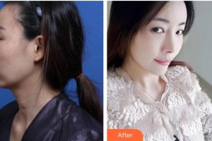 唐山金鳳凰美容整形醫(yī)院李春鵬整形價格表附鼻修復(fù)案例展示