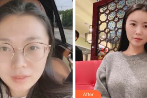 武漢伊萊美醫(yī)療美容門診部楊志華整形價格表附自體脂肪填充案例展示