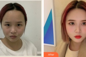 ?？邬i愛醫(yī)療美容醫(yī)院張曉陽整形價(jià)格表附皮膚美容案例展示