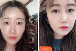 秦皇島釹娃（原女娃）醫(yī)療美容診所王艷整形價(jià)格表附熱瑪吉案例展示