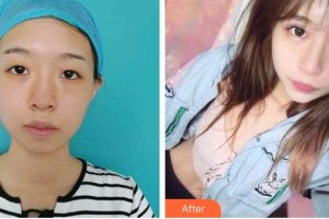 秦皇島紀(jì)輝整形美容醫(yī)院廉樂(lè)天整形價(jià)格表附眼部綜合案例展示