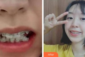 秦皇島口腔醫(yī)院由迪整形價(jià)格表附牙齒陶瓷矯正案例展示