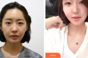 唐山光明醫(yī)院朱麗娜整形價格表附埋線提升案例展示