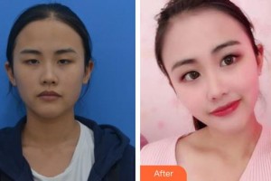 唐山頤安娜醫(yī)療美容門診部吳春艷整形價格表附下瞼整形案例展示