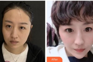 邯鄲曲勝星范醫(yī)療美容門診部曲勝整形價(jià)格表附埋線提升案例展示