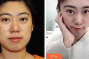 邢臺(tái)美在人生（原美聯(lián)臣）醫(yī)療美容診所王桂華整形價(jià)格表附埋線提升案例展示