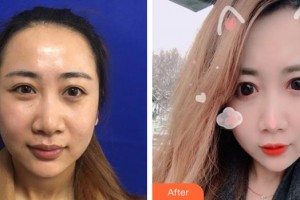 邢臺(tái)美在人生（原美聯(lián)臣）醫(yī)療美容診所韓晗整形價(jià)格表附埋線提升案例展示