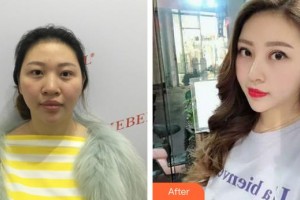邢臺(tái)廣慈整形美容醫(yī)院李中杰整形價(jià)格表附熱瑪吉案例展示