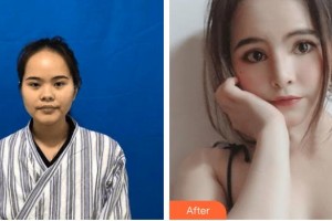 邢臺(tái)美在人生（原美聯(lián)臣）醫(yī)療美容診所劉洪達(dá)整形價(jià)格表附射頻緊膚案例展示