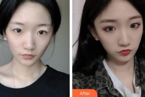 保定市第一中心醫(yī)院燒傷整形美容外科劉文禮整形價格表附定點雙眼皮案例展示