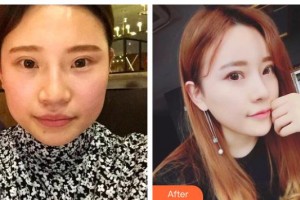 保定藍山醫(yī)療美容醫(yī)院杜健龍整形價格表附埋線提升案例展示