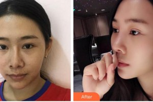 保定市第五醫(yī)院美容整形科楊瑞萍整形價格表附埋線提升案例展示