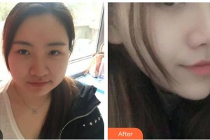 保定杏林中醫(yī)醫(yī)院整形外科從相文整形價格表附耳軟骨復合隆鼻案例展示
