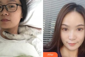 保定華仁皮膚病醫(yī)院激光美容中心劉敬整形價(jià)格表附埋線提升案例展示