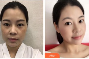 保定華仁皮膚病醫(yī)院激光美容中心張榮芳整形價(jià)格表附埋線提升案例展示