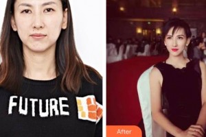 保定葉美思醫(yī)療美容診所霍玉釧整形價(jià)格表附超聲提拉案例展示