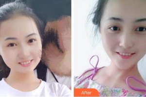 保定珍潤(rùn)醫(yī)療美容門診部王濤整形價(jià)格表附眼部綜合案例展示