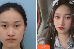 保定普濟(jì)醫(yī)療美容診所張杰整形價(jià)格表附眼部綜合案例展示