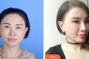 保定新視眼科醫(yī)院王穎整形價(jià)格表附切開(kāi)雙眼皮案例展示