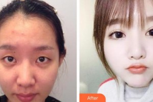 保定新視眼科醫(yī)院接英整形價(jià)格表附眼部綜合案例展示