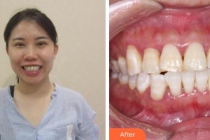 保定市口腔醫(yī)院王雙志整形價(jià)格表附牙齒隱形矯正案例展示