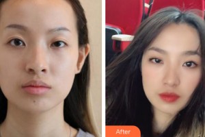 中山美南華整形美容醫(yī)院廖崇元整形價格表附植發(fā)案例展示