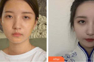 中山百佳婦產(chǎn)醫(yī)院醫(yī)療美容科馮鑫整形價(jià)格表附自體脂肪填充案例展示
