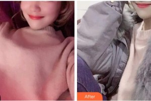 保定牙博士口腔醫(yī)院趙海紅整形價(jià)格表附超聲波潔牙案例展示
