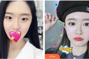 保定悅美醫(yī)療美容門診部孟令申整形價(jià)格表附切開(kāi)雙眼皮案例展示