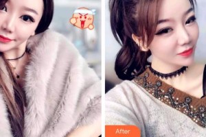 保定東陽(yáng)口腔醫(yī)院趙晨整形價(jià)格表附牙齒隱形矯正案例展示