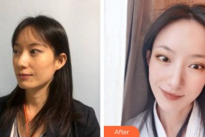 哈爾濱歐華醫(yī)療美容診所李東山整形價格表附皮膚美容案例展示