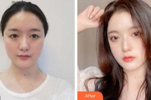 哈爾濱伊美爾光譜醫(yī)療美容門診部郝鐵英整形價格表附眼部手術案例展示