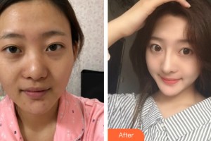 哈爾濱美聯(lián)致美整形醫(yī)院艾玉峰整形價格表附鼻部手術案例展示