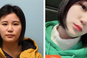 承德朝聚眼科醫(yī)院肖莉整形價(jià)格表附埋線(xiàn)雙眼皮案例展示