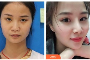 滄州龐大夫醫(yī)療美容診所龐麗娜整形價(jià)格表附假體隆鼻案例展示