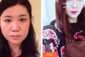 滄州市人民醫(yī)院燒傷整形科李勇整形價(jià)格表附假體隆鼻案例展示