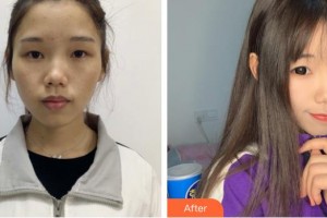 衡水天宏醫(yī)療美容醫(yī)院張浩整形價(jià)格表附激光祛斑案例展示