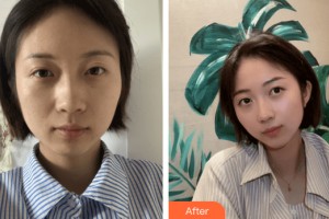 蘭州三愛(ài)整形美容醫(yī)院周媛整形價(jià)格表附皮膚美容案例展示