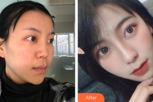 蘭州華夏醫(yī)院整形美容中心樊曉花整形價(jià)格表附隆鼻手術(shù)案例展示
