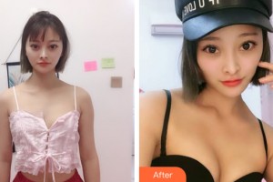 蘭州?；葆t(yī)療美容門診部莊成全整形價格表附隆胸手術(shù)案例展示