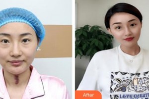 山西省眼科醫(yī)院唐桂蘭整形價(jià)格表附切開雙眼皮案例展示