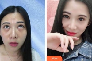 山西省眼科醫(yī)院劉剛整形價格表附內(nèi)切祛眼袋案例展示
