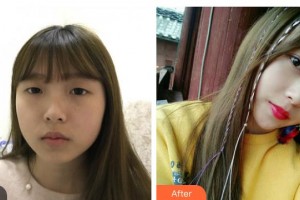 山西省眼科醫(yī)院屈宏波整形價(jià)格表附切開雙眼皮案例展示