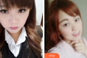 蘭州市口腔醫(yī)院李菁整形價格表附牙齒矯正案例展示