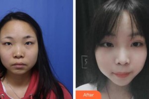 太原解放軍264醫(yī)院美容整形中心唐繼元整形價格表附祛妊娠紋案例展示