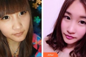 太原歐美蓮整形美容醫(yī)院劉小蓉整形價格表附耳軟骨復合隆鼻案例展示
