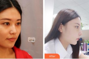 太原星范醫(yī)療美容門診部陳德裕整形價格表附鼻部綜合案例展示