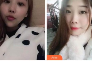 太原時光整形美容醫(yī)院洪愷志整形價格表附根管調(diào)節(jié)案例展示