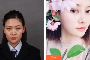 桂林創(chuàng)美醫(yī)療整形美容門診部張克勤整形價格表附鼻部手術(shù)案例展示